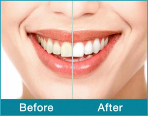 Smile-Before-After_full